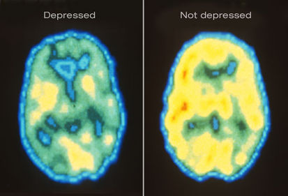 Princ rm pet scan of depressed brain.jpg